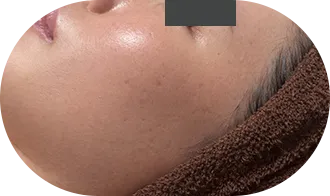 ハーブピーリング3ヶ月後:ニキビ跡が目立たない健康的な肌へ