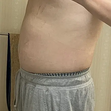 お腹周りのキャビテーション痩身 施術前（初回）