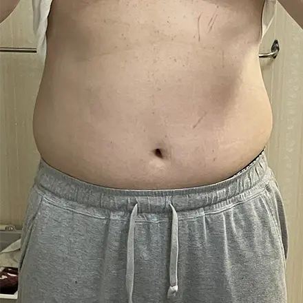 メンズ痩身 施術前（初回）